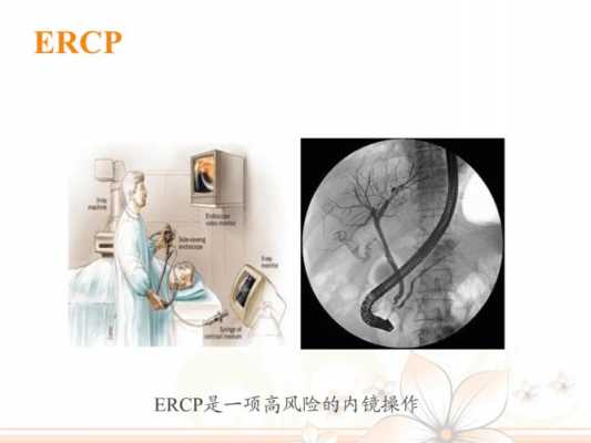 ercp医疗保险范围（ercp手术农保可以报销多少）